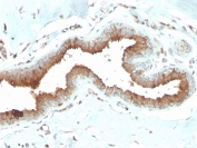Mammaglobin Antibody Mouse Monoclonal MGB/2704 immunohistochemistry of human breast carcinoma. FFPE human breast carcinoma tissue was stained with Mammaglobin Antibody Mouse Monoclonal (clone MGB/2704). HRP-DAB brown chromogenic signal highlights cytoplasmic staining in tumor epithelial cells lining glandular structures, consistent with Mammaglobin A / SCGB2A2 expression in breast carcinoma cells, while surrounding stromal cells and connective tissue show minimal staining. Heat-induced epitope retrieval was performed by boiling tissue sections in pH 9 10mM Tris with 1mM EDTA for 20 minutes followed by cooling prior to staining.
