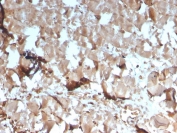 Creatine Kinase M Antibody Skeletal Muscle IHC. Immunohistochemistry analysis of FFPE human skeletal muscle tissue using Creatine Kinase M antibody. The mouse monoclonal antibody clone CKMM/3341 shows strong, diffuse cytoplasmic staining in skeletal myocytes, consistent with Creatine kinase M / CKM expression as a muscle energy metabolism marker. Myofiber cytoplasm displays robust signal reflecting high ATP demand associated with contractile activity, while non-muscle elements show minimal staining. HIER: boil tissue sections in 10 mM Tris with 1 mM EDTA, pH 9, for 20 min followed by cooling prior to staining.