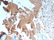 Creatine Kinase M Antibody Human Skeletal Muscle Tissue IHC. Immunohistochemistry staining of FFPE human skeletal muscle tissue with Creatine Kinase M antibody (clone CKMM/3341). HIER: boil tissue sections in pH 9 10mM Tris with 1mM EDTA for 20 min and allow to cool before testing.