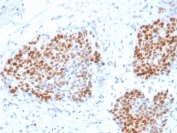 SOX9 Antibody Pancreas EMT IHC. Immunohistochemistry analysis of FFPE human pancreas using SOX9 Antibody. The recombinant rabbit monoclonal antibody clone SOX9/3916R demonstrates strong nuclear HRP-DAB brown staining in epithelial cell clusters, consistent with SOX9 expression in cells exhibiting epithelial plasticity and EMT-associated transcriptional activity. Surrounding stromal components show minimal staining, providing clear contrast of SOX9-positive populations. The observed pattern supports SOX9 as an EMT marker in pancreatic tissue. Heat-induced epitope retrieval was performed using pH 9 Tris-EDTA buffer to optimize nuclear antigen detection.