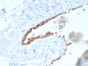 Mesothelin Antibody Mesothelioma IHC. Immunohistochemistry analysis of mesothelin expression in FFPE human lung mesothelioma using clone MSLN/3384. Distinct membranous HRP-DAB brown staining highlights tumor cell surfaces with focal cytoplasmic signal, consistent with cell surface localization of MSLN. The staining pattern clearly delineates mesothelioma cells from surrounding stromal components, supporting its use as a mesothelioma marker in tissue sections. Heat-induced epitope retrieval was performed in pH 9 Tris-EDTA buffer.