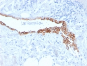 Mesothelioma Marker Antibody in Lung Tumor Tissue. Mesothelin antibody staining of FFPE human lung mesothelioma demonstrates strong membranous labeling of tumor cells using clone MSLN/3384. The crisp cell surface staining pattern emphasizes mesothelial differentiation and provides clear contrast against non-neoplastic tissue. This expression profile is consistent with known mesothelin distribution in mesothelioma. HIER: boiling in pH 9 Tris with EDTA followed by cooling prior to staining.