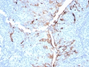 Mesothelin / MSLN Antibody Lung Mesothelioma IHC. Immunohistochemical detection of mesothelin (MSLN) in FFPE human lung mesothelioma using clone MSLN/3384 reveals prominent membranous HRP-DAB staining with partial cytoplasmic localization. Tumor cells exhibit strong, continuous surface labeling, aiding visualization of tumor architecture and mesothelial origin. The observed staining pattern aligns with established mesothelin expression in mesothelioma. Heat-induced epitope retrieval was performed using pH 9 Tris-EDTA buffer.