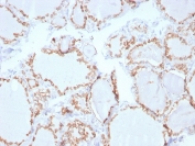 IHC staining of FFPE human thyroid carcinoma with Thyroid Peroxidase antibody. HIER: boil tissue sections in pH 9 10mM Tris with 1mM EDTA for 20 min and allow to cool before testing.