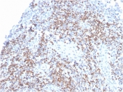ZAP70 Antibody / Immune Signal Transduction Antibody. Immunohistochemistry analysis of formalin-fixed, paraffin-embedded human tonsil tissue using ZAP70 Antibody / Immune Signal Transduction Antibody. Antigen retrieval was performed by boiling sections in pH 9 Tris-EDTA buffer for 20 minutes followed by cooling. Cytoplasmic HRP-DAB brown staining is observed in lymphoid cell populations within tonsillar follicles and interfollicular regions, consistent with Zeta-chain-associated protein kinase 70 (ZAP70) expression as a central mediator of immune signal transduction. The staining highlights active signaling networks within lymphocyte-rich regions and supports the use of ZAP70 for studying intracellular signal propagation in immune tissue architecture.