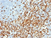 ZAP70 Antibody / Immune Signal Transduction Antibody. Immunohistochemistry analysis of formalin-fixed, paraffin-embedded human lymphoma tissue using ZAP70 Antibody / Immune Signal Transduction Antibody. Antigen retrieval was performed by boiling sections in pH 9 Tris-EDTA buffer for 20 minutes followed by cooling. Cytoplasmic HRP-DAB brown staining is observed in malignant lymphoid cells and surrounding lymphocyte populations, consistent with Zeta-chain-associated protein kinase 70 (ZAP70) expression as a key mediator of immune signal transduction. The staining pattern highlights active intracellular signaling networks within lymphoma tissue and supports the use of ZAP70 for evaluating signal propagation and pathway activity in lymphoid malignancy architecture.