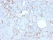 PAX8 Antibody / Renal Epithelial Lineage Marker Antibody immunohistochemistry in human kidney tissue showing nuclear HRP-DAB brown staining in renal tubular epithelial cells. Paired box protein Pax-8 (PAX8) expression is localized to nuclei lining nephron tubules, with clear staining of epithelial cells forming tubular structures and minimal signal in surrounding stromal or interstitial compartments. The staining pattern highlights renal epithelial lineage specificity, with strong nuclear positivity in tubular epithelium and absence of staining in non-epithelial cells. This distribution supports the use of PAX8 as a renal lineage marker in tissue-based analysis. HIER: boil tissue sections in pH 9 10mM Tris with 1mM EDTA for 20 min and allow to cool before testing.