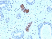 Mammaglobin Antibody - HuProt Validated immunohistochemistry of human breast carcinoma. FFPE human breast carcinoma tissue was stained with Mammaglobin Antibody - HuProt Validated (clone MGB/4056). HRP-DAB brown chromogenic signal highlights cytoplasmic staining in clusters of tumor epithelial cells within glandular structures, consistent with expression of Mammaglobin A / SCGB2A2 in breast carcinoma cells, while surrounding stromal cells show little to no staining. Heat-induced epitope retrieval was performed by boiling tissue sections in pH 9 10mM Tris with 1mM EDTA for 20 minutes followed by cooling prior to staining.