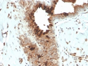 Mammaglobin Antibody - Microarray Specificity Validation (clone MGB/4057R) immunohistochemistry of human breast carcinoma. FFPE human breast carcinoma tissue was stained with Mammaglobin Antibody - Microarray Specificity Validation (clone MGB/4057R). HRP-DAB brown chromogenic signal highlights cytoplasmic staining in tumor epithelial cells lining glandular structures, consistent with expression of Mammaglobin A / SCGB2A2 in breast carcinoma cells, while surrounding stromal cells show little to no staining. Heat-induced epitope retrieval was performed by boiling tissue sections in pH 9 10mM Tris with 1mM EDTA for 20 minutes followed by cooling prior to staining.