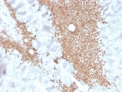 SATB2 Antibody Human Colon Adenocarcinoma IHC. Immunohistochemistry analysis of FFPE human colon carcinoma tissue stained with recombinant rabbit monoclonal clone SATB2/4374R. Dense nuclear HRP-DAB brown staining is observed throughout malignant glandular epithelial cells, consistent with expression of Special AT-rich sequence-binding protein 2 / SATB2, a colorectal lineage-associated transcriptional regulator involved in chromatin organization and epithelial differentiation pathways. Non-neoplastic stromal elements display comparatively limited background staining. HIER: boil tissue sections in pH 9 10mM Tris with 1mM EDTA for 20 min and allow to cool before testing.