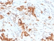 Mesothelin Antibody Mesothelioma IHC. Immunohistochemistry analysis of mesothelin expression in FFPE human mesothelioma using clone MSLN/3385. Tumor cells demonstrate membranous HRP-DAB brown staining with focal cytoplasmic signal, consistent with mesothelin surface localization. The staining pattern highlights mesothelial tumor cell populations while maintaining low background in surrounding stromal elements. The clear and selective signal is consistent with microarray specificity validated performance, supporting high-confidence detection of mesothelin in tissue sections. Heat-induced epitope retrieval was performed using pH 9 Tris-EDTA buffer.