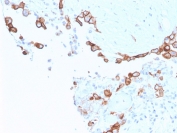 MSLN Antibody Mesothelioma IHC. Immunohistochemistry analysis of mesothelin (MSLN) expression in FFPE human mesothelioma. Tumor cells demonstrate membranous HRP-DAB brown staining with focal cytoplasmic signal, consistent with mesothelin cell surface localization and processing. The staining pattern highlights mesothelial tumor cell populations with low background in surrounding stromal elements. The clean, selective signal aligns with microarray specificity validated performance, supporting high-confidence detection of MSLN in tissue sections. Heat-induced epitope retrieval was performed using pH 9 Tris-EDTA buffer.