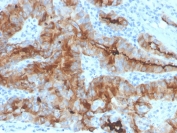 Immunohistochemistry analysis of Thyroglobulin antibody in human thyroid carcinoma tissue (clone rTGB/4744). FFPE human thyroid carcinoma sections demonstrate strong HRP-DAB brown cytoplasmic staining within tumor epithelial cells forming follicular and papillary structures, consistent with Thyroglobulin localization in differentiated thyroid epithelium. Luminal areas show dense brown chromogenic signal corresponding to secreted colloid material. Surrounding stromal cells display minimal to absent staining. Heat induced epitope retrieval was performed in 10 mM Tris with 1 mM EDTA, pH 9.0, by boiling tissue sections for 20 minutes followed by cooling prior to antibody incubation.