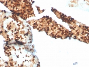S100P Antibody Recombinant Rabbit MAb S100P/4386R in human spleen tissue. Immunohistochemistry staining of FFPE human spleen demonstrates cytoplasmic staining in scattered inflammatory cells consistent with expression of S100 calcium binding protein P / S100P, also known as migration inducing gene 9 (MIG9). Brown chromogenic signal highlights S100P-positive inflammatory cells within splenic tissue while surrounding lymphoid populations show comparatively weaker staining. Heat-induced epitope retrieval was performed by boiling tissue sections in pH 9 Tris buffer with 1 mM EDTA for 20 min before staining.