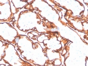EGFR L858R Antibody Placental Trophoblast IHC. Immunohistochemistry analysis of FFPE human placenta tissue stained with EGFR L858R mutation-specific antibody detecting mutant EGFR, clone GFR/4564R. Trophoblastic epithelial cells show membranous staining outlining cell borders with focal cytoplasmic signal. As normal placenta is not expected to harbor the L858R mutation, this staining should be interpreted cautiously and may reflect non-specific or low-level cross-reactivity. Hematoxylin counterstain highlights nuclei in blue. HIER: boil tissue sections in pH 9 10 mM Tris with 1 mM EDTA for 20 min and allow to cool before testing.