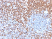 ZAP70 Antibody / Kinase Activation Regulation Antibody. Immunohistochemistry analysis of formalin-fixed, paraffin-embedded human tonsil tissue using ZAP70 Antibody / Kinase Activation Regulation Antibody. Antigen retrieval was performed by boiling sections in pH 9 Tris-EDTA buffer for 20 minutes followed by cooling. Cytoplasmic HRP-DAB brown staining is observed in lymphoid cell populations surrounding lighter germinal center regions, consistent with Zeta-chain-associated protein kinase 70 (ZAP70) expression and its tightly regulated, phosphorylation-dependent kinase activity. The staining pattern highlights compartmentalized lymphocyte populations within tonsillar architecture, supporting the role of ZAP70 in controlled activation and regulation of immune signaling within lymphoid tissue.
