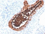 Immunohistochemistry analysis of Recombinant MUC16 Antibody in FFPE human ovarian carcinoma tissue. Strong membranous and apical cytoplasmic HRP-DAB brown staining is observed in malignant epithelial cells, consistent with overexpression of MUC16 / CA125 in ovarian carcinoma, while surrounding stromal cells are largely negative. Clone OCA125/4505R demonstrates clear epithelial surface localization. Heat-induced epitope retrieval was performed in pH 9 Tris-EDTA buffer (10mM Tris, 1mM EDTA) for 20 minutes followed by cooling prior to staining.