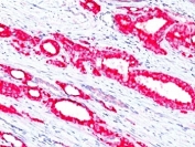 p504S Antibody Prostate Carcinoma IHC. Immunohistochemistry staining of formalin-fixed, paraffin-embedded human prostate carcinoma tissue using clone 13H4 demonstrates strong granular cytoplasmic red chromogenic staining in malignant prostatic epithelial cells, consistent with the characteristic expression pattern of Alpha-methylacyl-CoA racemase / AMACR in prostate adenocarcinoma. The staining highlights neoplastic glandular architecture with comparatively minimal background signal in surrounding stromal tissue.