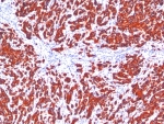 IHC staining of FFPE human breast carcinoma tissue with Pan Cytokeratin Antibody SPM115/SPM116. HIER: boil tissue sections in pH 9 10mM Tris with 1mM EDTA for 20 min and allow to cool before testing.