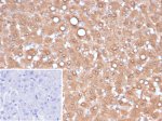 Arginase 1 Antibody ARG1/6790R by IHC in Human Hepatocellular Carcinoma. Immunohistochemistry of FFPE human hepatocellular carcinoma tissue using Arginase 1 Antibody ARG1/6790R, a recombinant rabbit monoclonal antibody. Strong, diffuse brown DAB staining is observed predominantly in the cytoplasm of tumor cells, with occasional nuclear staining and variable cytoplasmic intensity. The staining pattern is consistent with ARG1 expression in hepatocellular carcinoma and its role as a marker of hepatocellular differentiation. Nuclei are counterstained blue with hematoxylin. The lower-left inset shows a secondary-only negative control, with PBS substituted for the primary antibody, demonstrating minimal background staining.