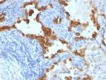 IHC staining of FFPE human lung carcinoma tissue with Cytokeratin 8/18 antibody (clone SPM192 + SPM265). HIER: boil tissue sections in pH 9 10mM Tris with 1mM EDTA for 20 min and allow to cool before testing.