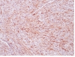 ALK Antibody IMT Spindle Cell IHC. Immunohistochemistry staining of FFPE human inflammatory myofibroblastic tumor tissue using recombinant monoclonal clone ALK1/7008R demonstrates diffuse cytoplasmic HRP-DAB brown staining within spindle-shaped myofibroblastic tumor cells arranged in fascicular stromal patterns. The observed staining profile supports expression of ALK fusion-associated kinase protein in inflammatory myofibroblastic tumor-associated mesenchymal cellular populations. HIER: boil tissue sections in pH 9 10mM Tris with 1mM EDTA for 20 min and allow to cool before testing.
