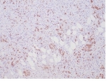 ALK Antibody ALCL Stromal Interface IHC. Immunohistochemistry staining of FFPE human anaplastic large cell lymphoma tissue using recombinant monoclonal clone ALK1/7008R demonstrates scattered cytoplasmic HRP-DAB brown staining in malignant lymphoid cells distributed within fibrotic and adipose-associated stromal compartments. The staining pattern is consistent with ALK fusion protein-associated expression in ALK-positive lymphoma and highlights oncogenic kinase signaling within neoplastic hematolymphoid cellular populations. HIER: boil tissue sections in pH 9 10mM Tris with 1mM EDTA for 20 min and allow to cool before testing.