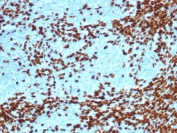 IHC staining of FFPE human thymoma tissue with recombinant TdT antibody recombinant rabbit mAb clone DNTT/4617R. HIER: boil tissue sections in pH 9 10mM Tris with 1mM EDTA for 20 min and allow to cool before testing.