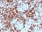 DNA nucleotidylexotransferase Antibody Thymus Immunohistochemistry. IHC staining of FFPE human thymus tissue with DNA nucleotidylexotransferase antibody (clone DNTT/4506R). HIER: boil tissue sections in pH 9 10mM Tris with 1mM EDTA for 20 min and allow to cool before testing.
