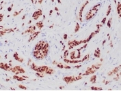 Progesterone Receptor Antibody Recombinant Rabbit MAb PGR/6854R immunohistochemistry analysis of Progesterone receptor / PGR in human breast carcinoma tissue. FFPE human breast carcinoma tissue was stained with Progesterone Receptor Antibody Recombinant Rabbit MAb PGR/6854R following heat induced epitope retrieval by boiling sections in pH 9 10mM Tris with 1mM EDTA for 20 minutes prior to cooling and staining. HRP-DAB brown chromogenic signal reveals nuclear staining in tumor epithelial cells, consistent with the nuclear localization of Progesterone receptor (PGR) in hormone-responsive breast cancer. PR immunohistochemistry staining is widely used in breast cancer diagnostics to evaluate progesterone receptor expression in tumor epithelial cells and to assess hormone receptor status alongside ER and HER2 in breast carcinoma.