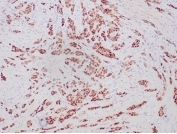 Progesterone Receptor Antibody Recombinant Rabbit MAb PGR/6854R immunohistochemistry analysis of Progesterone receptor / PGR in human breast carcinoma. FFPE human breast carcinoma tissue was stained with the recombinant rabbit monoclonal Progesterone Receptor Antibody PGR/6854R following heat induced epitope retrieval by boiling sections in pH 9 10mM Tris with 1mM EDTA for 20 minutes prior to cooling and staining. HRP-DAB brown chromogenic signal demonstrates nuclear staining in malignant epithelial cells within glandular tumor structures, consistent with the nuclear localization of Progesterone receptor (PGR). PR immunohistochemistry staining is widely used in breast cancer diagnostics to evaluate progesterone receptor expression in tumor epithelial cells and determine hormone receptor status alongside ER and HER2.