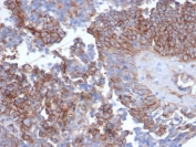 N-Cadherin Antibody Ovarian Carcinoma IHC. Immunohistochemistry staining of FFPE human ovarian carcinoma tissue with recombinant N-Cadherin antibody (clone CDH2/6857R). HIER: boil tissue sections in pH 9 10mM Tris with 1mM EDTA for 20 min and allow to cool before testing.