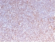 Anaplastic Lymphoma Kinase Antibody ALCL IHC. Immunohistochemistry staining of FFPE human anaplastic large cell lymphoma tissue using recombinant mouse monoclonal clone rALK1/1504 demonstrates extensive nuclear and cytoplasmic HRP-DAB brown staining in malignant lymphoid cells, consistent with expression of oncogenic ALK fusion-associated kinase protein in ALK-positive lymphoma. The diffuse staining pattern supports the established role of Anaplastic Lymphoma Kinase rearrangement-driven signaling in lymphoma pathobiology and precision oncology-associated biomarker analysis. HIER: boil tissue sections in pH 9 10mM Tris with 1mM EDTA for 20 min and allow to cool before testing.