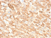 Albumin Antibody Liver Carcinoma IHC. Immunohistochemistry staining of FFPE human liver carcinoma in colon tissue with recombinant Albumin antibody (clone ALB/6413R). HIER: boil tissue sections in pH 9 10mM Tris with 1mM EDTA for 20 min and allow to cool before testing.