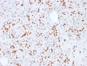 SOX9 Antibody Pancreas IHC. Immunohistochemistry analysis of FFPE human pancreatic tissue using SOX9 Antibody. The recombinant monoclonal antibody clone SOX9/2387 demonstrates strong nuclear HRP-DAB brown staining in ductal epithelial cells and scattered progenitor-like cell populations, consistent with SOX9âs role as a transcription factor and cancer stem cell-associated marker. Minimal staining is observed in surrounding stromal components. Heat-induced epitope retrieval was performed using pH 9 Tris-EDTA buffer, supporting robust nuclear signal detection in pancreatic tissue.