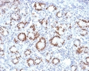 SOX9 Antibody Gastric Cancer IHC. Immunohistochemistry analysis of FFPE human gastric carcinoma tissue using SOX9 Antibody. The recombinant monoclonal antibody clone SOX9/2387 demonstrates strong nuclear HRP-DAB brown staining in tumor epithelial cells, with focal enrichment in gland-forming regions, consistent with SOX9 expression in proliferative and progenitor-like tumor compartments. Surrounding stromal cells show minimal staining. The observed pattern supports SOX9âs role as a cancer stem cell-associated transcription factor in gastric carcinoma. Heat-induced epitope retrieval was performed using pH 9 Tris-EDTA buffer to optimize nuclear antigen detection.