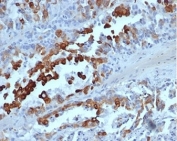 Cytokeratin 20 Antibody Recombinant Mouse MAb rKRT20/6536. Immunohistochemistry analysis of FFPE human colon adenocarcinoma tissue using recombinant mouse monoclonal Cytokeratin 20 antibody (clone rKRT20/6536). HRP-DAB brown chromogenic staining highlights cytoplasmic Keratin 20 / Cytokeratin 20 (KRT20) expression in malignant epithelial cells forming glandular structures, while surrounding stromal cells remain largely negative. The staining pattern is consistent with the epithelial localization of this intermediate filament protein in colorectal adenocarcinoma. HIER: boil tissue sections in pH 9 10 mM Tris with 1 mM EDTA for 20 min and allow to cool before testing.