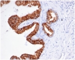 IHC staining of FFPE human prostate carcinoma tissue with recombinant EpCAM antibody (clone rEGP40/826). HIER: boil tissue sections in pH 9 10mM Tris with 1mM EDTA for 20 min and allow to cool before testing.