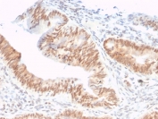 CSTF2T Antibody Colon Adenocarcinoma IHC. Immunohistochemistry analysis of FFPE human colon adenocarcinoma tissue stained with clone PCRP-CSTF2T-1A3. Tumor epithelial cells show prominent nuclear and perinuclear HRP-DAB brown staining, consistent with the known function of Cleavage stimulation factor subunit 2 tau / CSTF2T in nuclear RNA processing and mRNA maturation. Adjacent stromal cells show comparatively low background staining. HIER: boil tissue sections in pH 9 10mM Tris with 1mM EDTA for 20 min and allow to cool before testing.