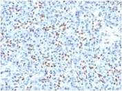 SOX9 Antibody Human Pancreatic Tissue IHC. Immunohistochemistry analysis of SOX9 Antibody / Microarray Specificity Validated Antibody in FFPE human pancreas tissue. The recombinant monoclonal antibody clone PCRP-SOX9-1A2 demonstrates distinct nuclear HRP-DAB brown staining in pancreatic ductal epithelial cells, consistent with the expected nuclear localization of SOX9 as a transcription factor. Acinar cells show minimal to absent staining, while surrounding stromal components remain largely negative, supporting specificity of signal. The clear nuclear staining pattern highlights SOX9 expression in ductal and progenitor-associated epithelial compartments. Microarray-validated specificity supports reliable interpretation of staining in immunohistochemistry and tissue microarray applications. Heat-induced epitope retrieval was performed using 10 mM Tris with 1 mM EDTA, pH 9, by boiling for 20 minutes followed by cooling prior to staining.