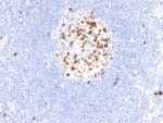 Topoisomerase II alpha Antibody / Cell Cycle Regulator Antibody (clone rTOP2A/6629). Immunohistochemistry analysis of FFPE human lymph node demonstrates strong nuclear staining of DNA Topoisomerase II alpha in proliferating lymphoid cells. Nuclear immunoreactivity is concentrated within germinal center lymphocytes, reflecting the elevated expression of this cell cycle regulator in rapidly dividing immune cells. As a Cell Cycle Regulator Antibody, clone rTOP2A/6629 highlights cells undergoing active cell cycle progression, particularly those approaching the G2/M phase transition when Topoisomerase II alpha activity is required for chromosome organization prior to mitosis. HIER: boil tissue sections in pH 9 Tris-EDTA buffer for 20 min followed by cooling at RT before immunohistochemistry staining.
