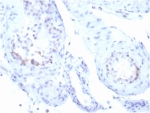 StAR Antibody Recombinant Rabbit MAb STAR/3915R. Immunohistochemistry analysis of Steroidogenic Acute Regulatory Protein (StAR / STARD1) in FFPE human testicular carcinoma tissue using a recombinant rabbit monoclonal antibody. HRP-DAB brown cytoplasmic staining highlights tumor cells with steroidogenic differentiation, consistent with the mitochondrial localization of StAR in steroid hormone-producing cells, while surrounding stromal elements show minimal staining. Heat-induced epitope retrieval was performed by boiling tissue sections in pH 9 Tris-EDTA buffer (10mM Tris with 1mM EDTA) for 20 minutes followed by cooling prior to antibody staining.