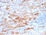 KRT8 Antibody Human Colon Tissue IHC. Immunohistochemical staining of FFPE human colon tissue using recombinant KRT8 Antibody (clone rKRT8/6471) demonstrates strong cytoplasmic and membranous HRP-DAB brown staining throughout epithelial cell populations. The staining pattern is consistent with expression of Cytokeratin 8 (KRT8/CK8), a type II intermediate filament protein that supports epithelial cytoskeletal organization, structural integrity, and cellular stress-response functions. KRT8 immunoreactivity highlights epithelial morphology and tissue architecture within the colon, while adjacent stromal and lymphoid elements show comparatively limited staining. HIER: boil tissue sections in pH 9 10 mM Tris with 1 mM EDTA for 20 minutes and allow to cool before testing.