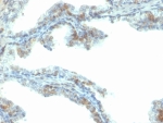 ERG Antibody Prostate Cancer Tissue IHC. Immunohistochemistry of FFPE human prostate carcinoma tissue using ERG antibody highlights strong HRP-DAB brown nuclear staining in tumor epithelial cells, consistent with ERG expression associated with TMPRSS2-ERG fusion-driven prostate cancer, with endothelial cells in surrounding vasculature also showing nuclear positivity; clone ERG/2107 was used for detection. HIER: boil tissue sections in pH 9 10mM Tris with 1mM EDTA for 20 min and allow to cool before testing.