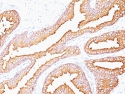 PSA Antibody Mouse Monoclonal for IHC (clone SPM352) immunohistochemistry of human prostate carcinoma. IHC analysis of FFPE human prostate carcinoma tissue using PSA Antibody Mouse Monoclonal for IHC (clone SPM352) shows strong HRP-DAB brown cytoplasmic staining in malignant prostate epithelial cells lining irregular glandular lumina, consistent with Prostate specific antigen (KLK3) expression in prostate-derived tumor epithelium, while surrounding stromal cells remain largely negative. Antigen retrieval was performed by boiling tissue sections in 10 mM Tris with 1 mM EDTA, pH 9 for 10-20 minutes followed by cooling at room temperature for 20 minutes before testing.