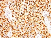 Myogenin Antibody Clone SPM144 immunohistochemistry analysis of Myogenin in human rhabdomyosarcoma. Formalin-fixed paraffin-embedded human rhabdomyosarcoma tissue stained with Myogenin antibody shows strong HRP-DAB brown chromogenic staining localized to the nuclei of tumor cells. The staining highlights numerous malignant cells with distinct nuclear positivity consistent with the role of Myogenin / MYOG as a nuclear transcription factor involved in skeletal muscle differentiation. Surrounding stromal elements show minimal staining, while tumor cell nuclei demonstrate the characteristic nuclear pattern associated with rhabdomyosarcoma.