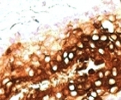 IHC: Formalin-fixed, paraffin-embedded human skin stained with CK17/Cytokeratin 17 antibody clone SPM560.