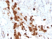 Immunohistochemistry analysis of ACTH in human pituitary tissue. Formalin-fixed, paraffin-embedded human pituitary gland tissue was stained using ACTH/Adrenocorticotropic hormone antibody (clone SPM333), showing granular cytoplasmic staining in scattered pituitary cells consistent with hormone-containing corticotrophs. Antigen retrieval was performed by heating sections in 10 mM Tris with 1 mM EDTA, pH 9.0, at 95oC for 45 minutes, followed by cooling at room temperature for 20 minutes.