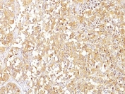 Gp100 Antibody Clone SPM142. Immunohistochemistry analysis of formalin-fixed, paraffin-embedded human melanoma tissue stained with Gp100 Antibody Clone SPM142. Melanoma tumor cells show cytoplasmic HRP-DAB brown chromogenic staining consistent with expression of gp100 / PMEL17, a melanosome-associated protein characteristic of melanocytic lineage. Positive staining highlights melanoma tumor cells throughout the tissue section, while surrounding stromal components show minimal background staining.