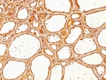 TG Antibody Clone SPM517. Immunohistochemistry analysis of Thyroglobulin using TG Antibody Clone SPM517 in FFPE human thyroid carcinoma tissue. HRP-DAB brown chromogenic staining highlights strong cytoplasmic signal in thyroid follicular tumor cells forming follicular structures, with additional staining of luminal colloid material. The staining pattern is consistent with the known expression of Thyroglobulin in differentiated thyroid follicular epithelium and thyroid-derived tumors.